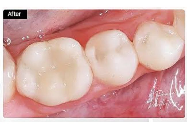 Điều trị tủy răng