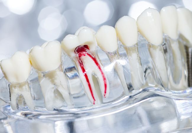 Điều trị tủy răng