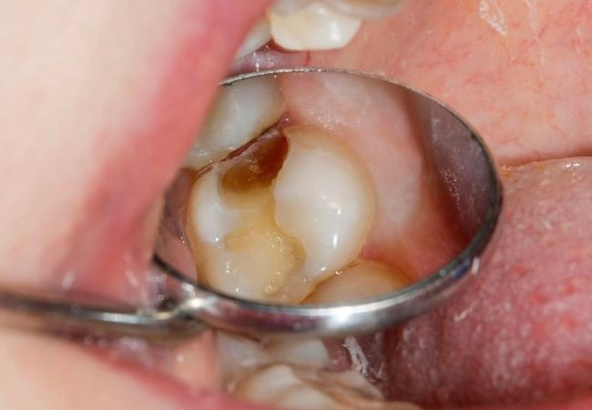 Điều trị tủy răng