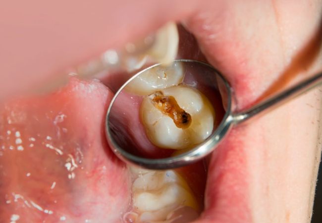 Điều trị tủy răng