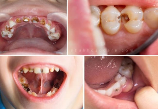 Điều trị tủy răng