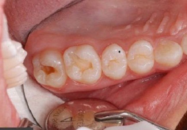 Điều trị tủy răng