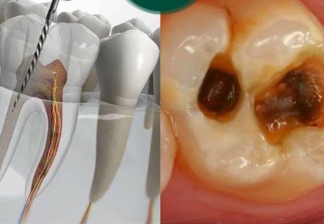 Điều trị tủy răng