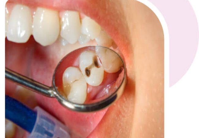 Điều trị tủy răng