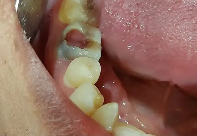 Điều trị tủy răng