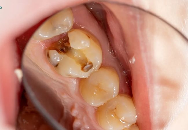 Điều trị tủy răng