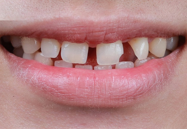 1.Bao nhiêu tuổi thì nên can thiệp đóng khoảng răng thưa để đạt hiệu quả tốt nhất?