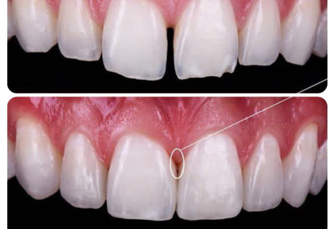 2.Trám răng thưa thẩm mỹ giá bao nhiêu? Bảng giá chuẩn tại Nha Khoa Bảo Việt