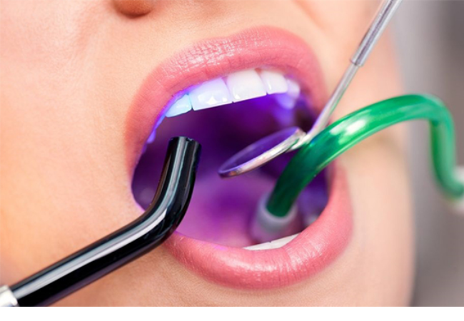 3.Trám răng thưa thẩm mỹ giá bao nhiêu? Bảng giá chuẩn tại Nha Khoa Bảo Việt