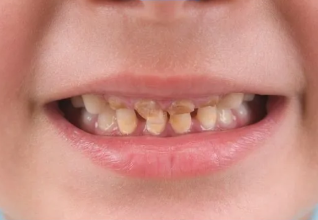 Nước súc miệng