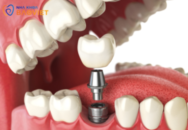 3.Giá cấy implant phụ thuộc vào những yếu tố nào? Hướng dẫn cách tối ưu chi phí