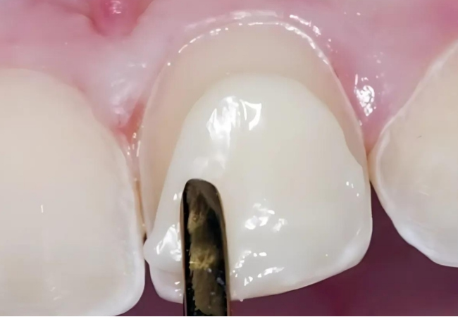 4.Trám răng thưa thẩm mỹ giá bao nhiêu? Bảng giá chuẩn tại Nha Khoa Bảo Việt