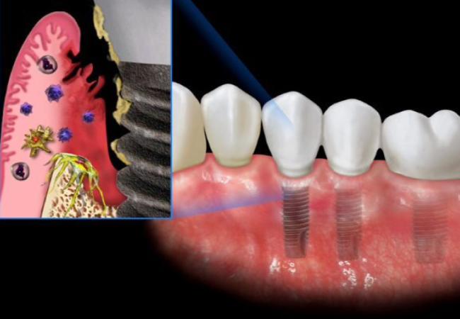 5.Giá cấy implant phụ thuộc vào những yếu tố nào? Hướng dẫn cách tối ưu chi phí