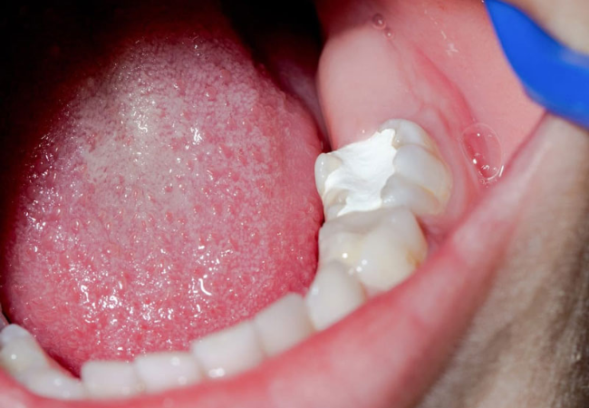 5.Bao nhiêu tuổi thì nên can thiệp đóng khoảng răng thưa để đạt hiệu quả tốt nhất?
