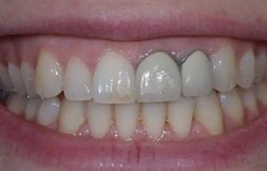 Sự Thật: Răng cửa bọc răng sứ Titan có đảm bảo thẩm mỹ không?