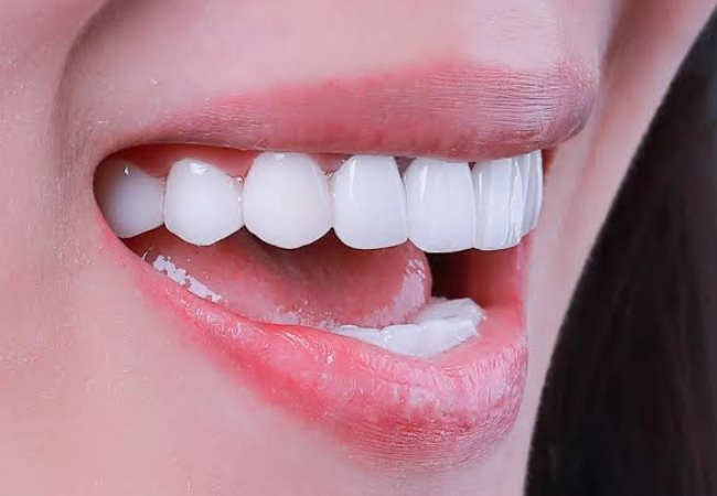 tẩy trắng răng