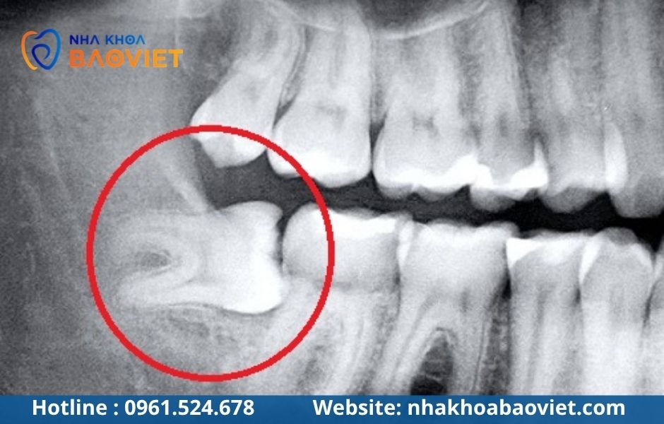 Răng khôn mọc lệch 90 độ (mọc ngang): Biến chứng và giải pháp xử lý
