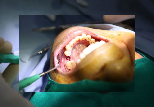 Implant