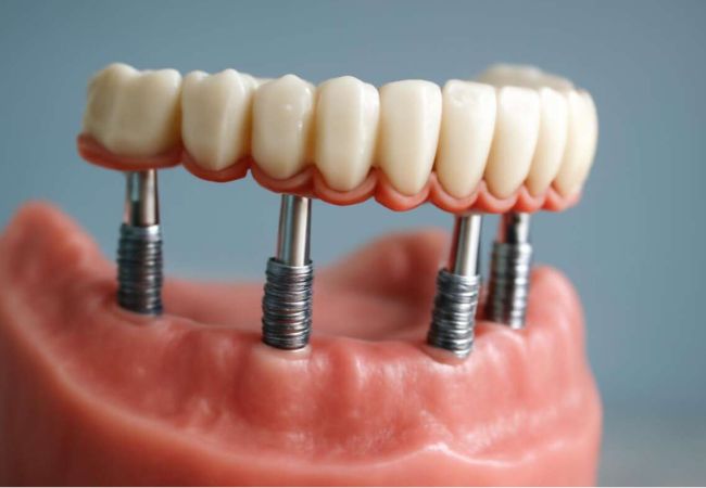 Implant