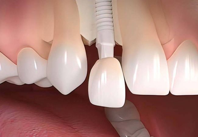 Implant