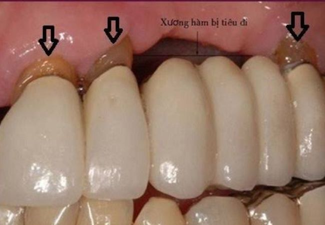 Implant