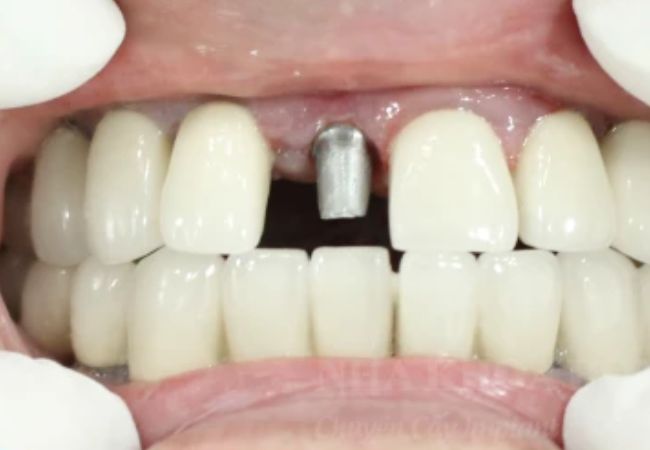 Implant