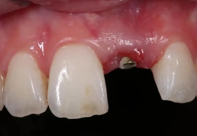 Implant