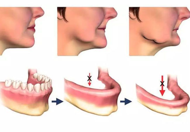 Implant