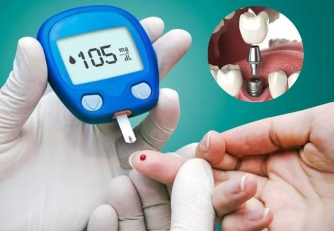 Implant