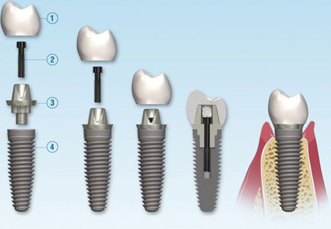 Implant