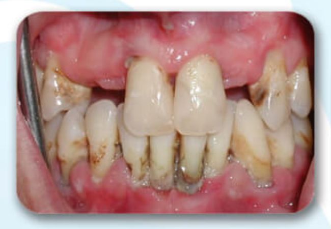 Implant