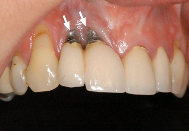 Implant