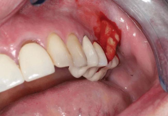 Implant