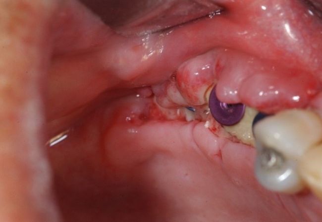 Implant