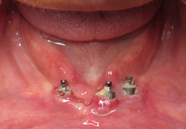 Implant