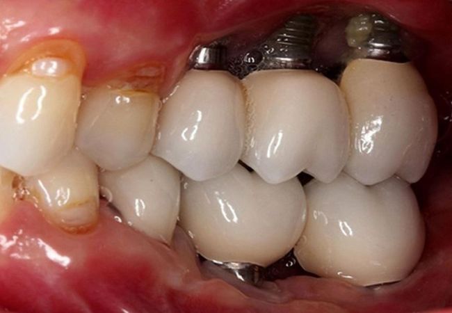 Implant