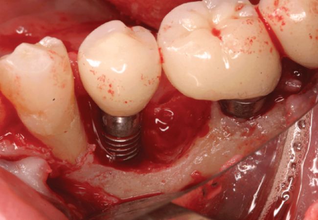 Implant