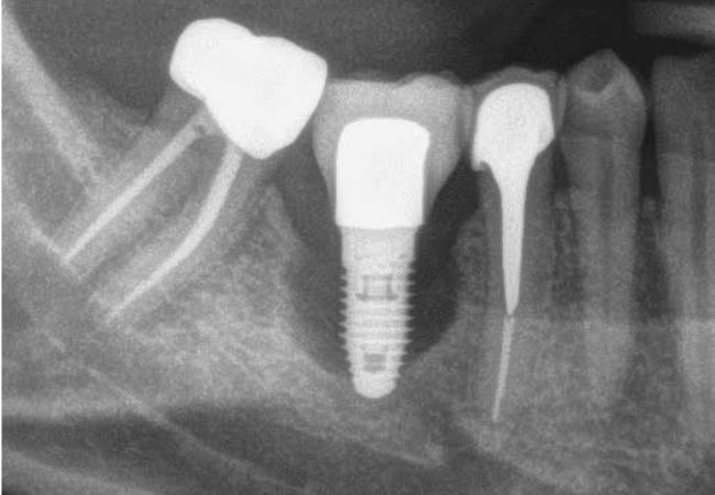 Implant