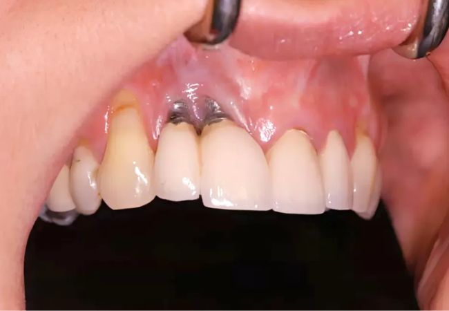 Implant