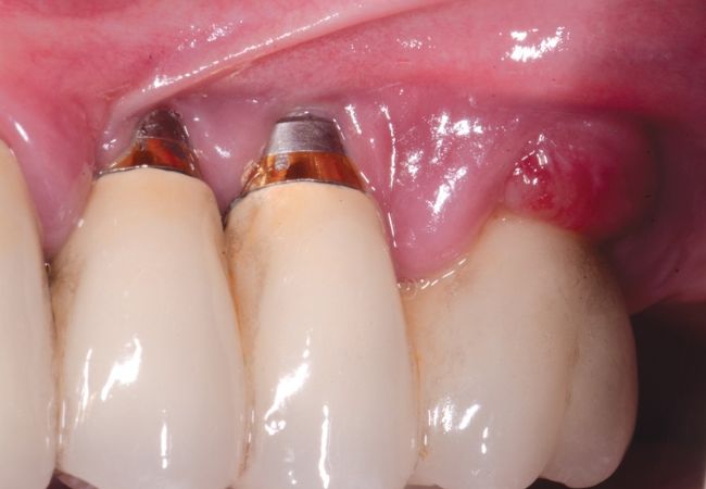 Implant
