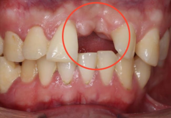 Implant