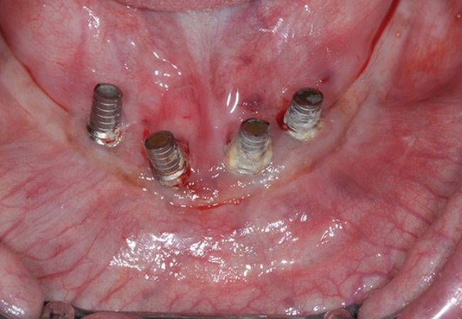 Implant