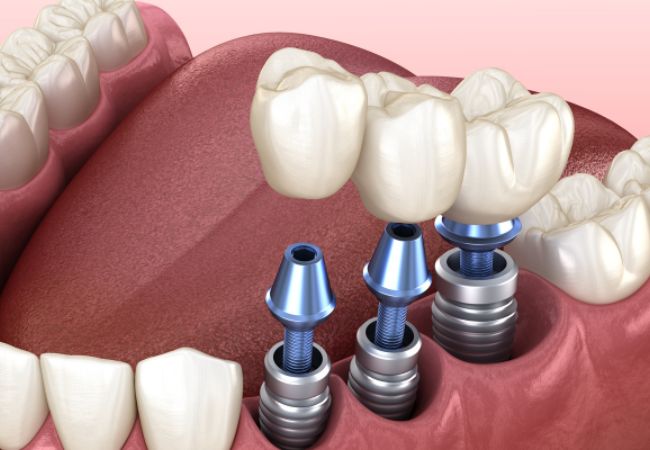 Implant