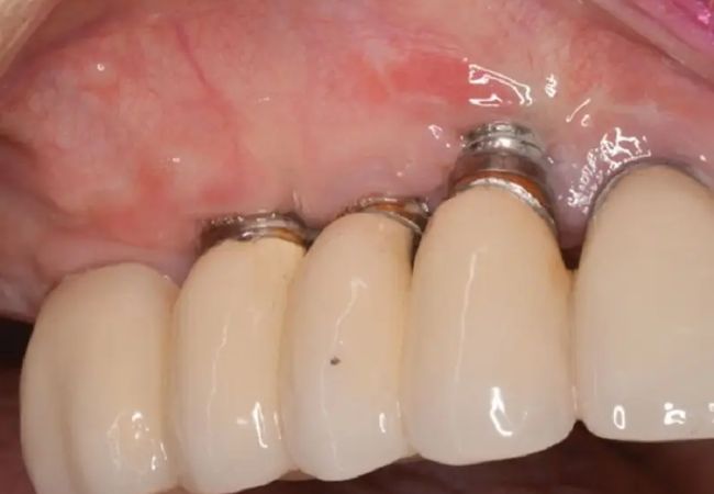 Implant