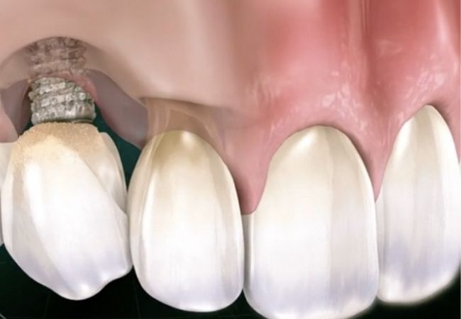 Implant