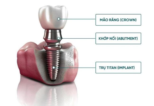 Implant