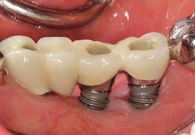 Implant