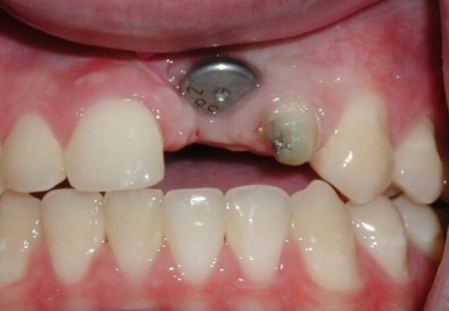 Implant