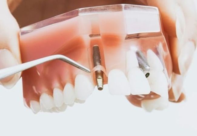 Implant