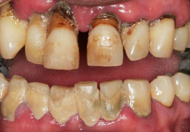 Implant